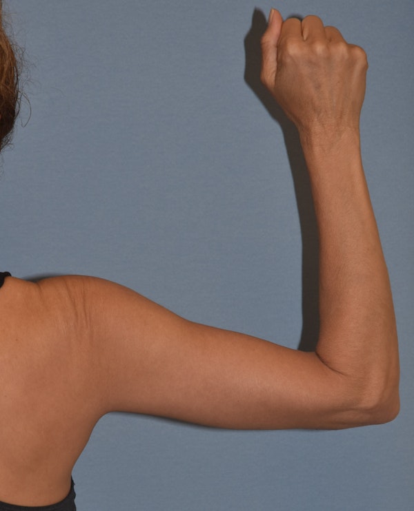 Arm Lift Before & After Gallery - Patient 202496 - Image 4