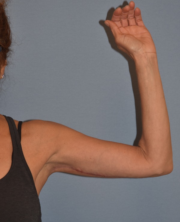 Arm Lift Before & After Gallery - Patient 202496 - Image 2