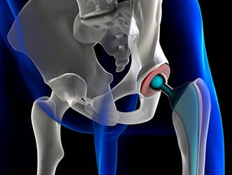 hip replacement illustration