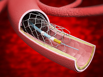 illustration of a medical stint