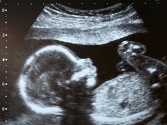 ultrasound of a baby