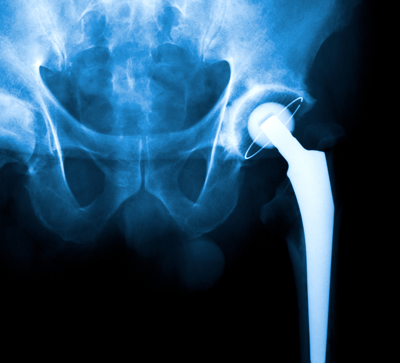 Stryker Femoral Head Recall Chicago