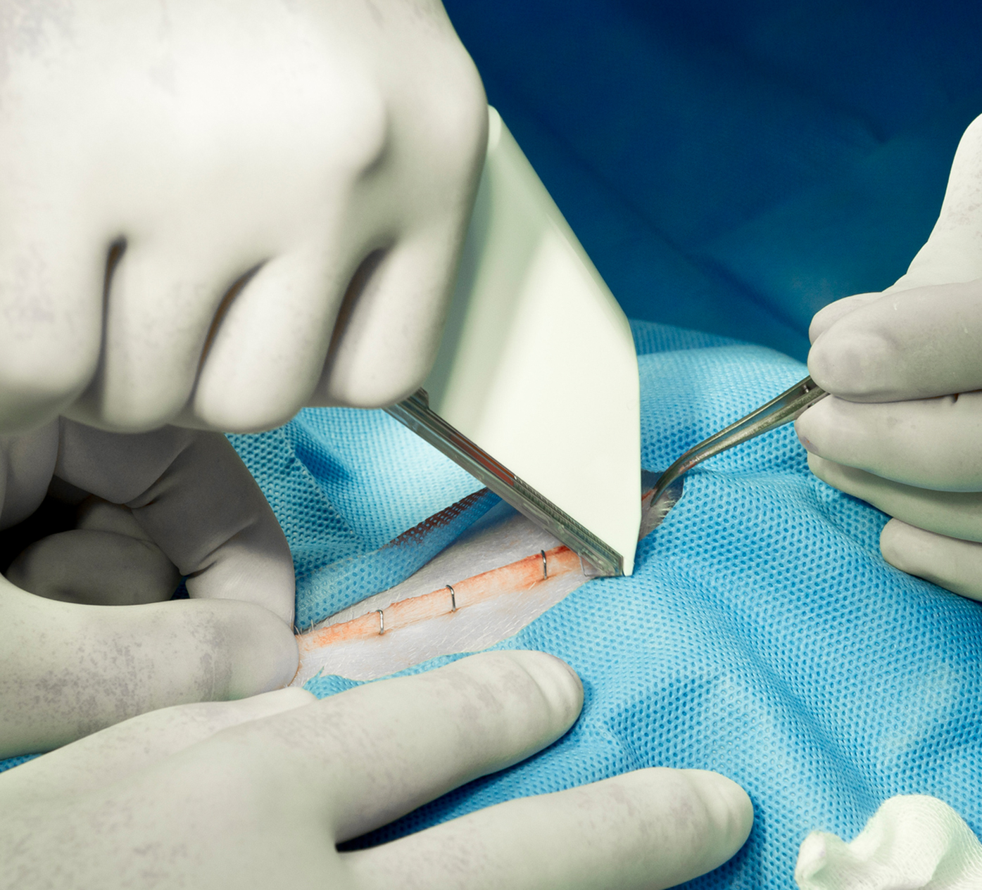 Surgical Stapler Injury Lawyer Meyers & Flowers