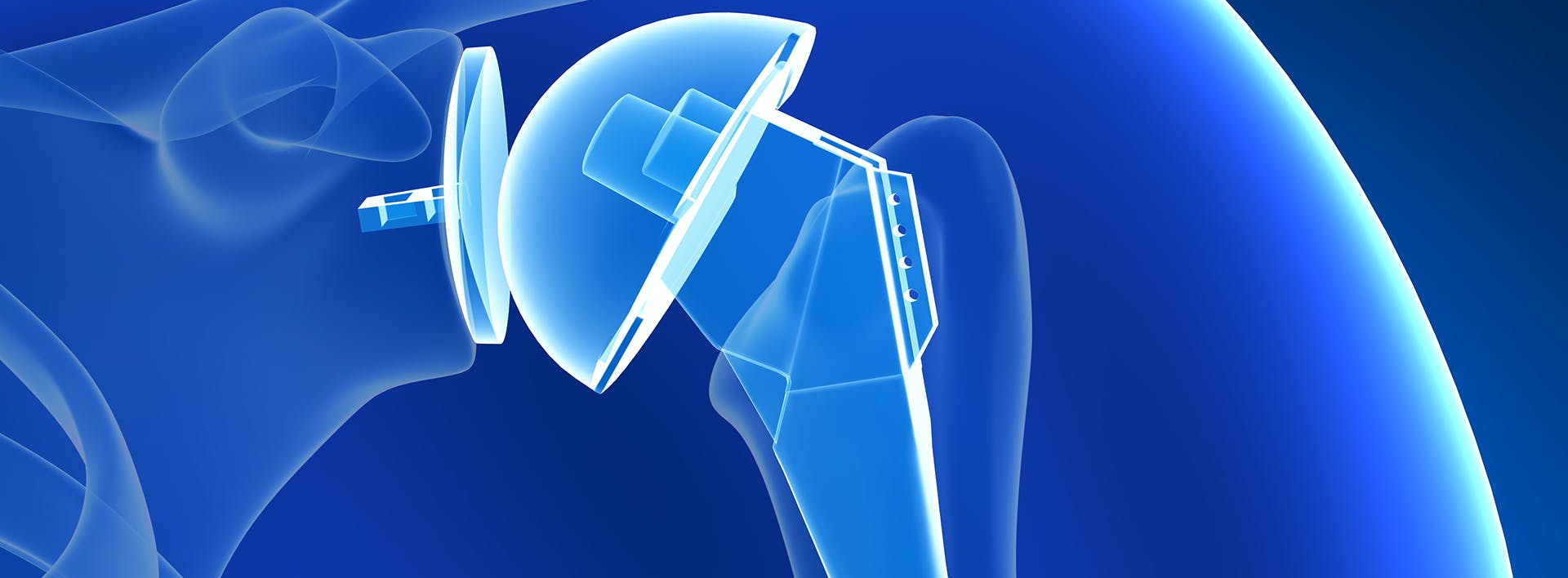 hip replacement device
