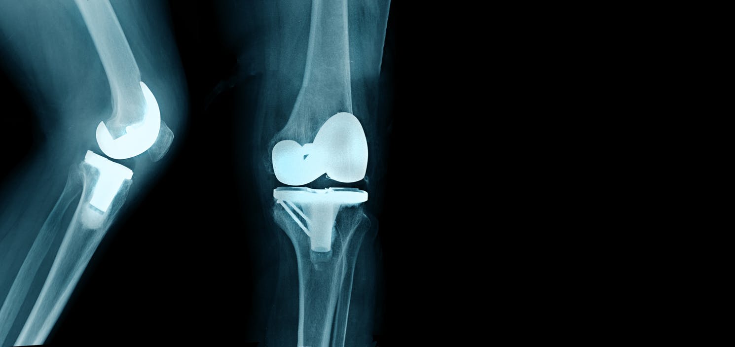 xray of a knee replacement