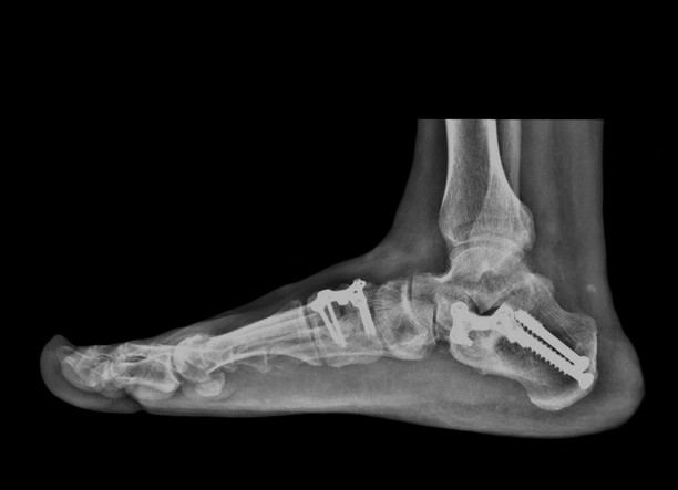 xray of an ankle implant