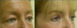 Hazen Plastic Surgery and Medspa Blog | The Benefits of Blepharoplasty