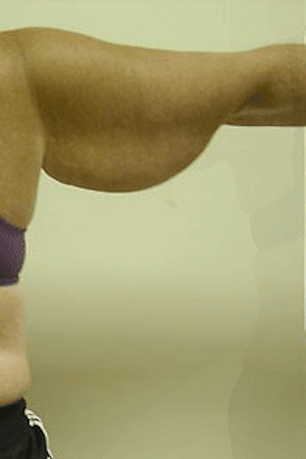 Arm Lift