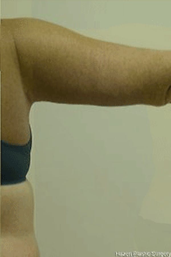 Arm Lift Before & After Gallery - Patient 9605545 - Image 2