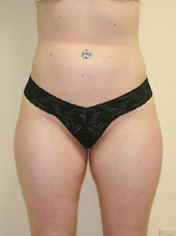 Liposuction
