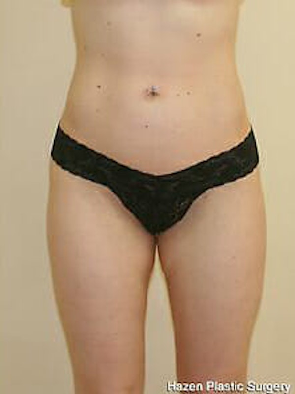 Liposuction