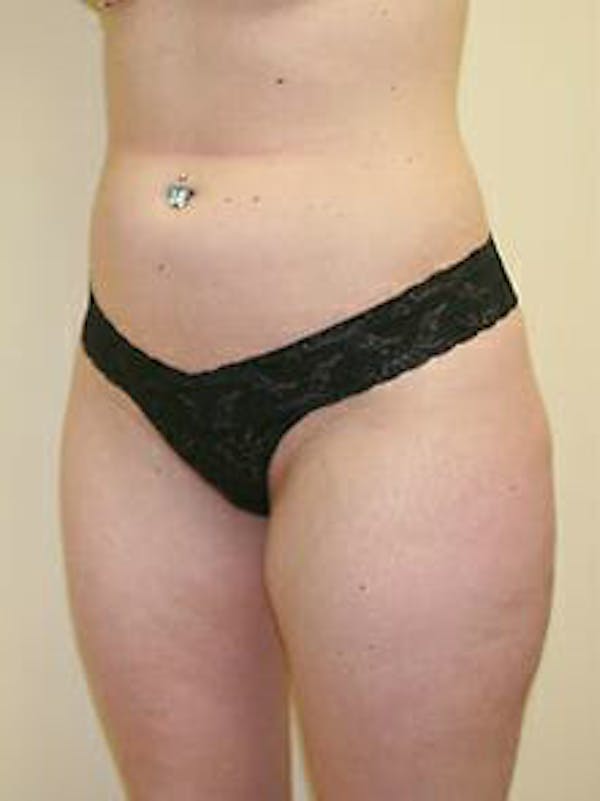 Female Liposuction Before & After Gallery - Patient 9605548 - Image 3