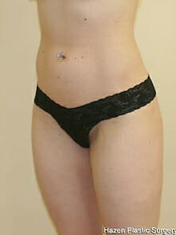 Female Liposuction Before & After Gallery - Patient 9605548 - Image 4