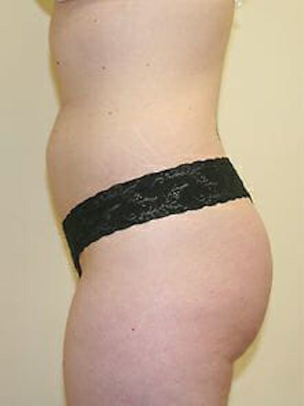 Female Liposuction Before & After Gallery - Patient 9605548 - Image 5