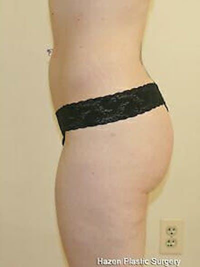 Female Liposuction Before & After Gallery - Patient 9605548 - Image 6