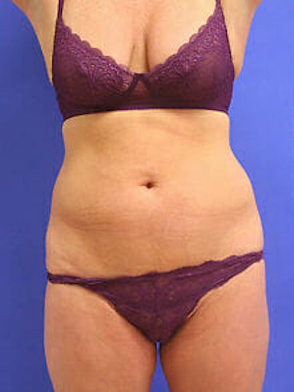 Female Liposuction Before & After Gallery - Patient 9605550 - Image 1
