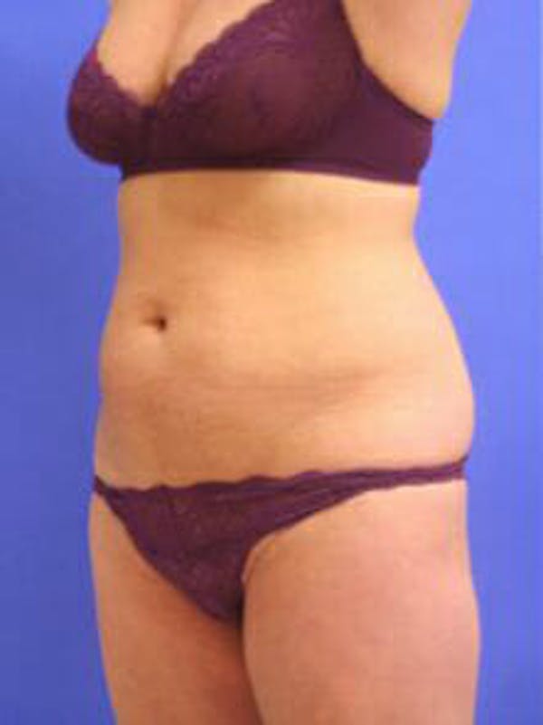 Female Liposuction Before & After Gallery - Patient 9605550 - Image 3