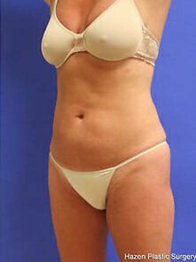 Female Liposuction Before & After Gallery - Patient 9605550 - Image 4