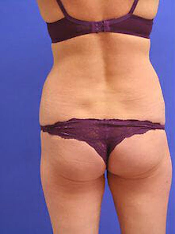 Female Liposuction Before & After Gallery - Patient 9605550 - Image 5