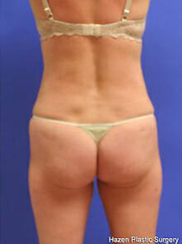 Female Liposuction Before & After Gallery - Patient 9605550 - Image 6