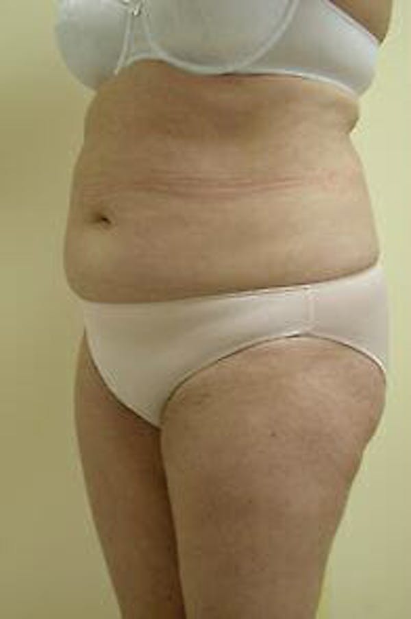 Female Liposuction Gallery - Patient 9605553 - Image 1