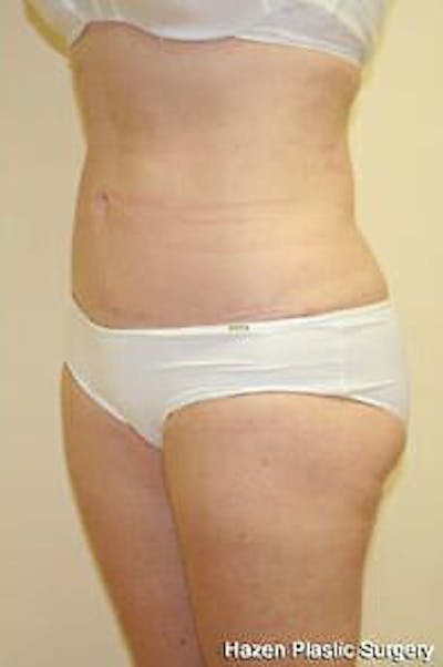 Female Liposuction Before & After Gallery - Patient 9605553 - Image 2
