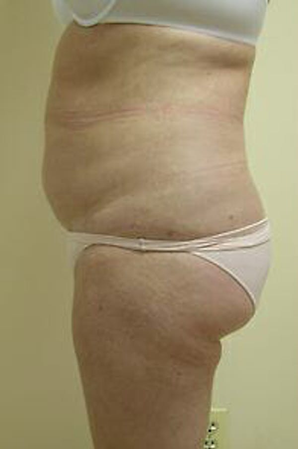 Female Liposuction Before & After Gallery - Patient 9605553 - Image 3