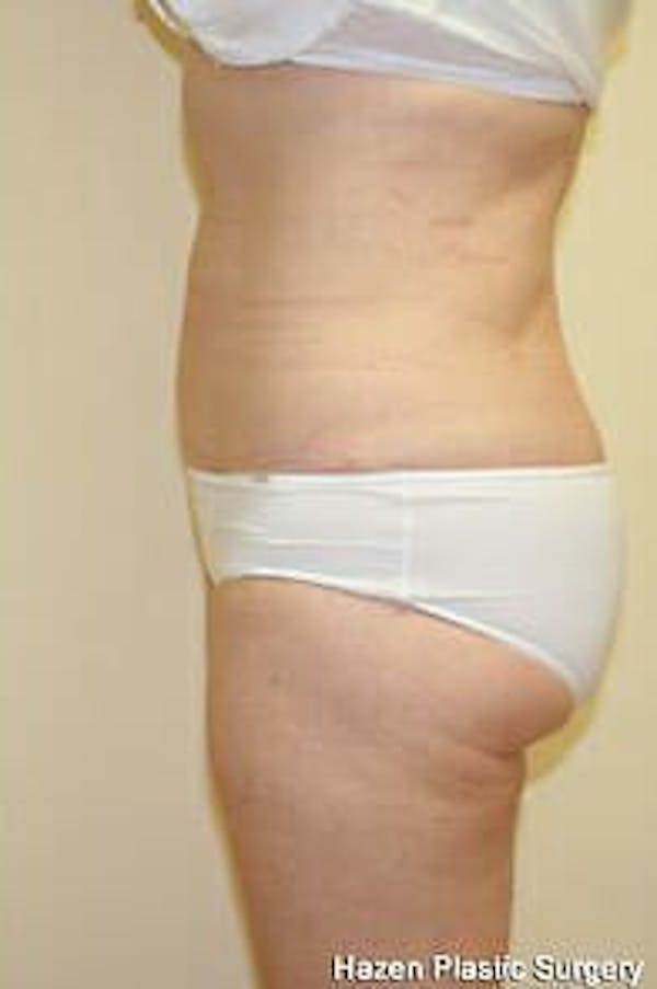 Female Liposuction Before & After Gallery - Patient 9605553 - Image 4