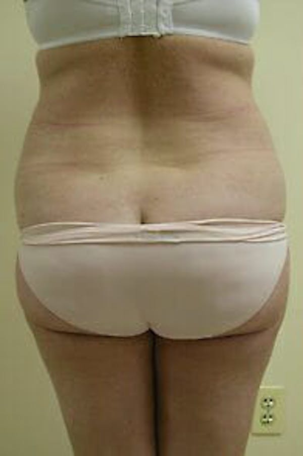 Female Liposuction Before & After Gallery - Patient 9605553 - Image 5