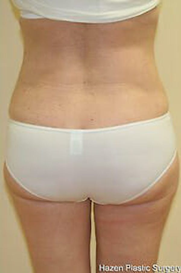 Female Liposuction Before & After Gallery - Patient 9605553 - Image 6