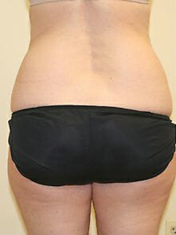Female Liposuction Before & After Gallery - Patient 9605554 - Image 1
