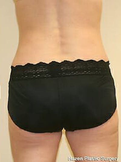 Female Liposuction Before & After Gallery - Patient 9605554 - Image 2