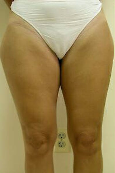 Female Liposuction Before & After Gallery - Patient 9605557 - Image 1