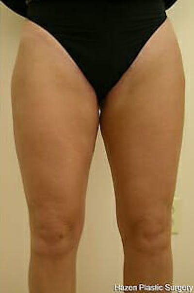 Female Liposuction Before & After Gallery - Patient 9605557 - Image 2