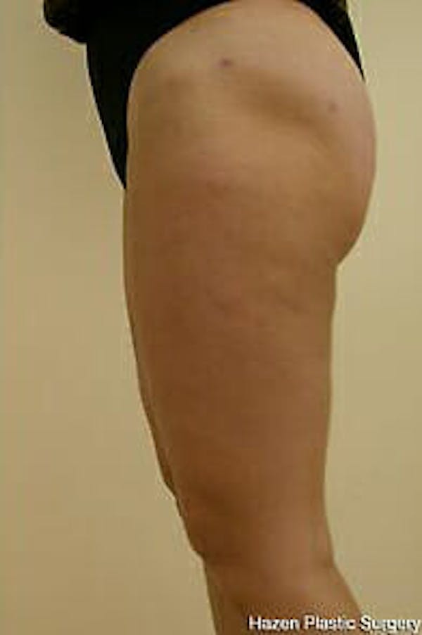 Female Liposuction Before & After Gallery - Patient 9605557 - Image 3