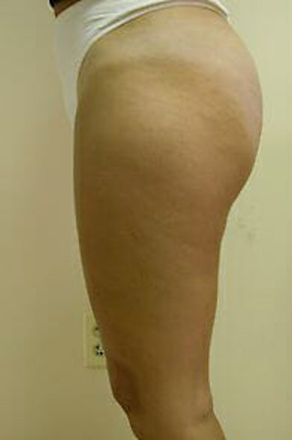 Female Liposuction Before & After Gallery - Patient 9605557 - Image 4