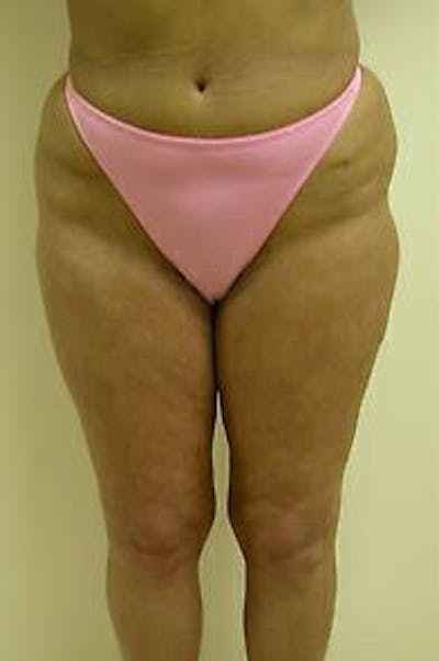 Female Liposuction Gallery - Patient 9605559 - Image 1
