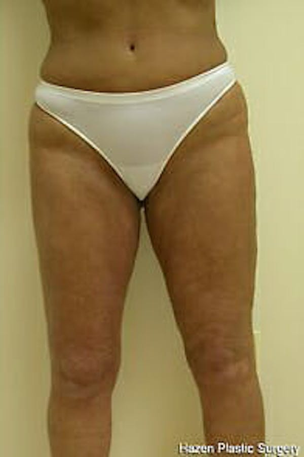 Female Liposuction Gallery - Patient 9605559 - Image 2