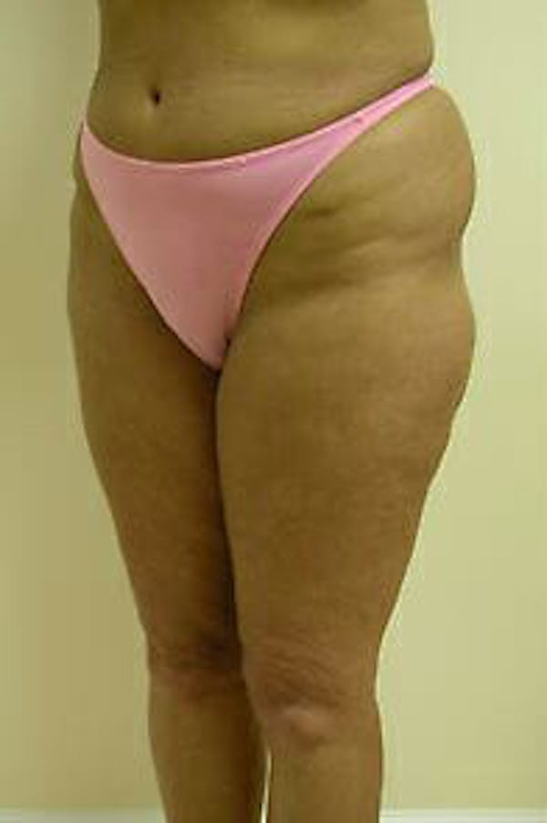 Female Liposuction Before & After Gallery - Patient 9605559 - Image 3