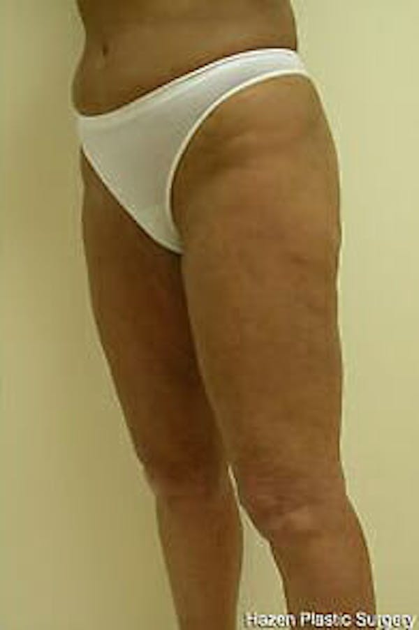 Female Liposuction Gallery - Patient 9605559 - Image 4