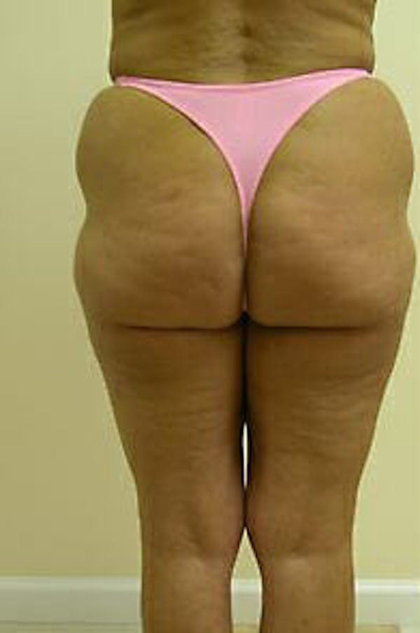 Female Liposuction Before & After Gallery - Patient 9605559 - Image 5