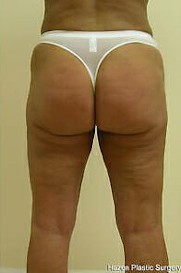 Female Liposuction Before & After Gallery - Patient 9605559 - Image 6
