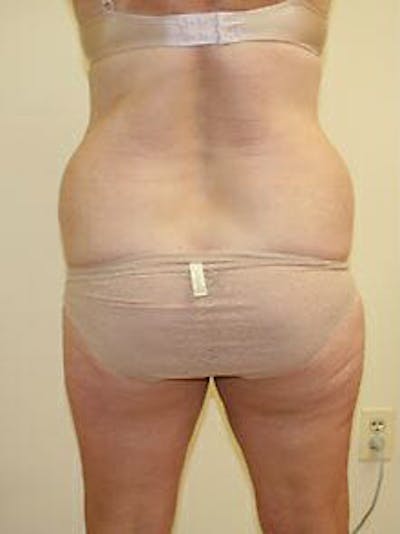 Female Liposuction Before & After Gallery - Patient 9605561 - Image 1