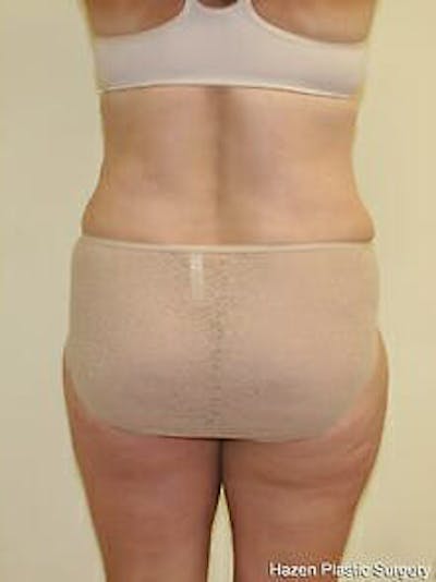 Female Liposuction Before & After Gallery - Patient 9605561 - Image 2