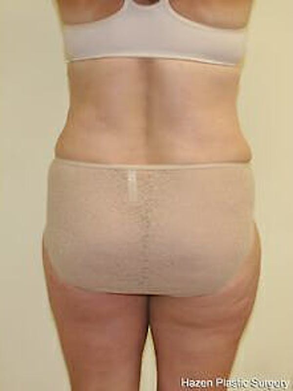 Female Liposuction Before & After Gallery - Patient 9605561 - Image 2
