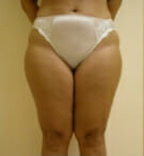 Female Liposuction Before & After Gallery - Patient 9605563 - Image 1