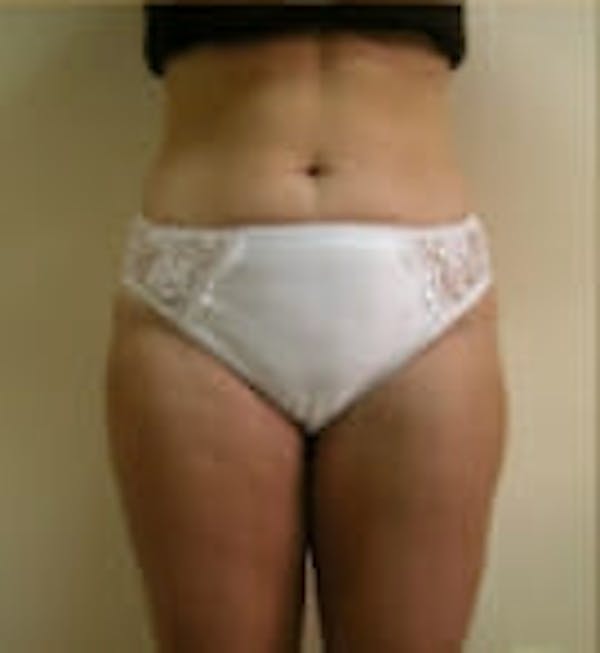 Female Liposuction Before & After Gallery - Patient 9605563 - Image 2