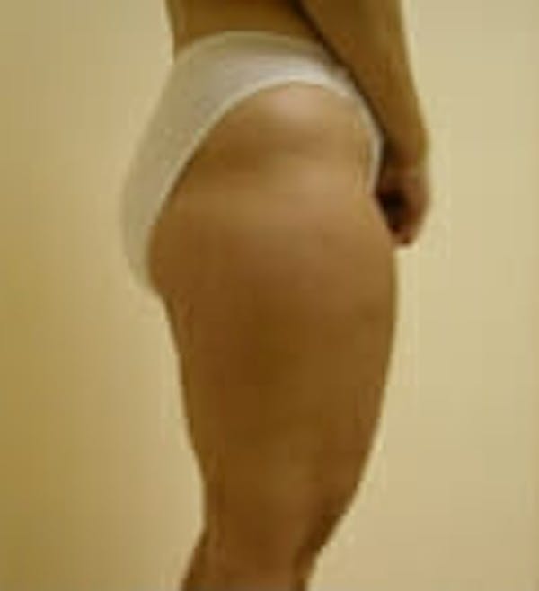 Female Liposuction Before & After Gallery - Patient 9605563 - Image 3