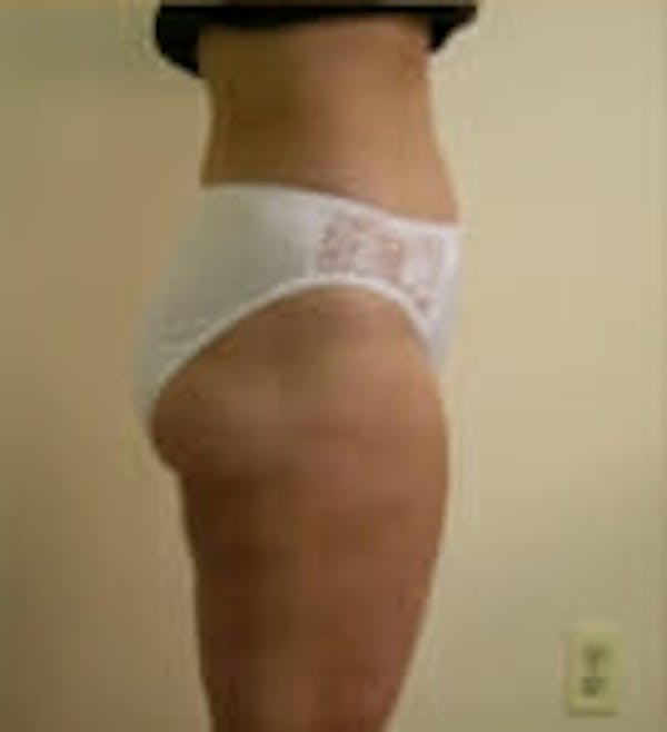 Female Liposuction Before & After Gallery - Patient 9605563 - Image 4