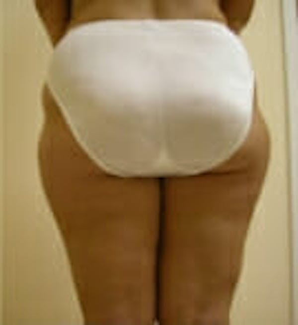 Female Liposuction Before & After Gallery - Patient 9605563 - Image 5